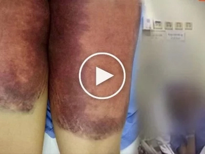 Mother seeks justice for 18-year-old daughter - abused, burned, paddled during brutal hazing