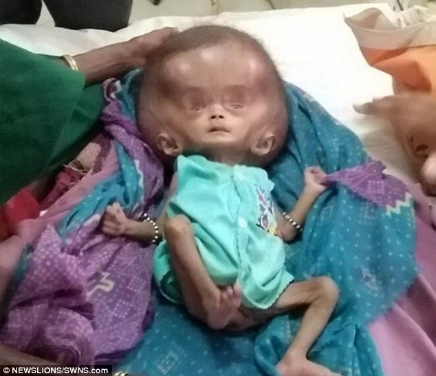 Parents seeking help for their daughter born with head more than TWICE size of normal (photos) Parents seeking help for their daughter born with head more than TWICE size of normal (photos)