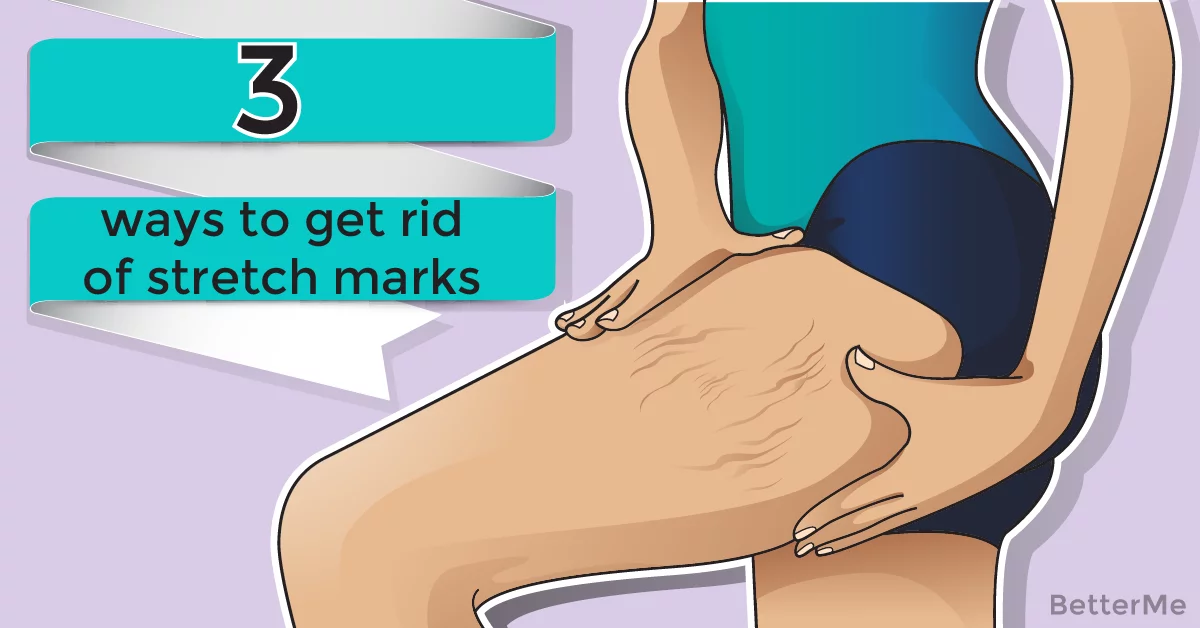 tazorac gel for stretch marks