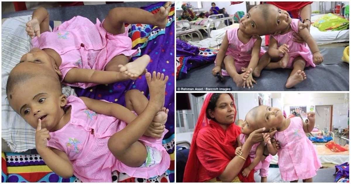 Young conjoined twins set to undergo life-threatening surgery to separate them (photos)