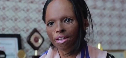 Her friends shunned her because of her scarred face but the story behind is horrifying
