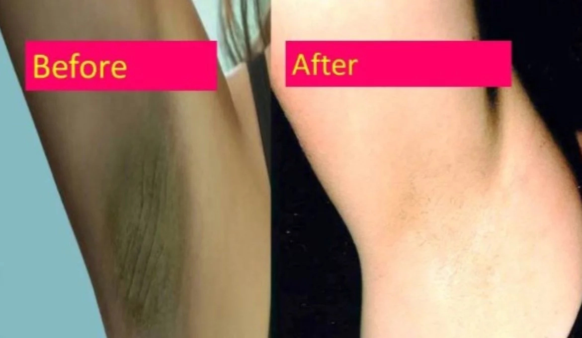 Here's How Lemon Can Help You With Getting Rid Of Dark Under Arms Here's How Lemon Can Help You With Getting Rid Of Dark Under Arms