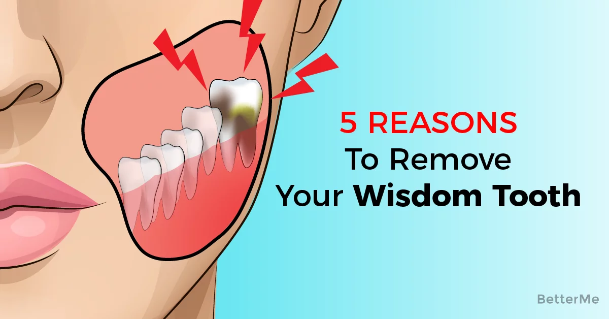 There are 5 signs that you need your wisdom teeth removed. 