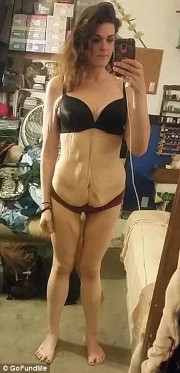Woman loses 240 lbs but retains sagging skin Woman loses 240 lbs but retains sagging skin