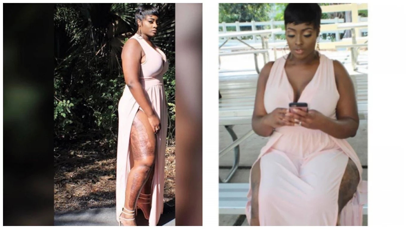 Woman who narrowly escaped death by fire shares her inspiring survival story 8 months later Woman who narrowly escaped death by fire shares her inspiring survival story 8 months later