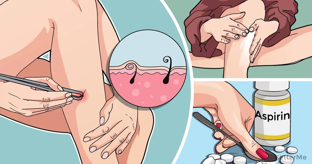 5 Natural Ways That Can Help You Get Rid Of Ingrown Hairs