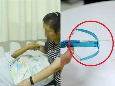 Boy’s eye shot with toothpick by his classmate. Eyesight permanently damaged
