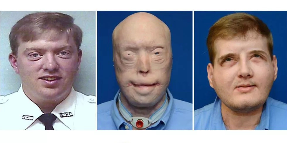 This man received the most extensive face transplant surgery This man received the most extensive face transplant surgery
