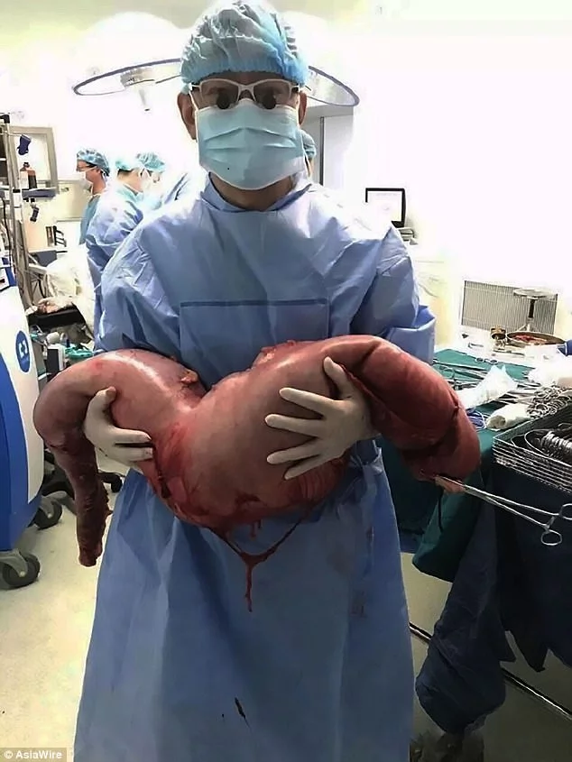 This man was heavily constipated his entire life. Upon surgery, doctors removed 22 years worth of accumulated feces! Ugh! This man was heavily constipated his entire life. Upon surgery, doctors removed 22 years worth of accumulated feces! Ugh!