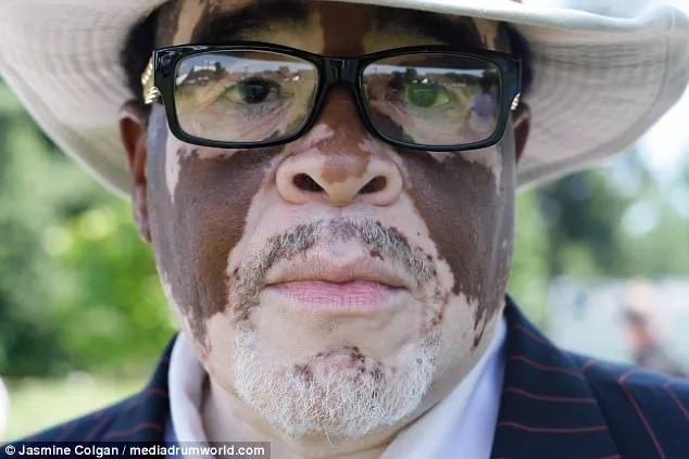 Colgan also hopes to inspire people with vitiligo to be proud of their skin. Photo" Jasmin Colgan Colgan also hopes to inspire people with vitiligo to be proud of their skin. Photo" Jasmin Colgan
