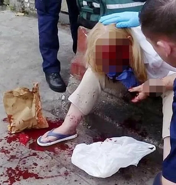 See the consequences of a horrific hammer attack on a woman! See the consequences of a horrific hammer attack on a woman!