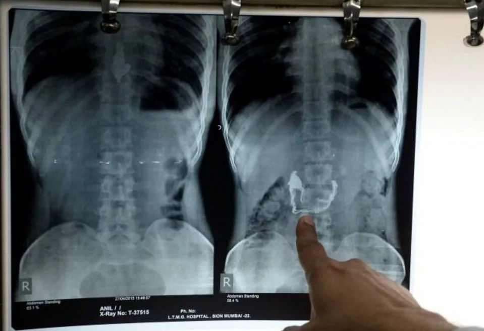 Man who swallowed 40 KNIVES rushed to hospital in agony (photos, video)