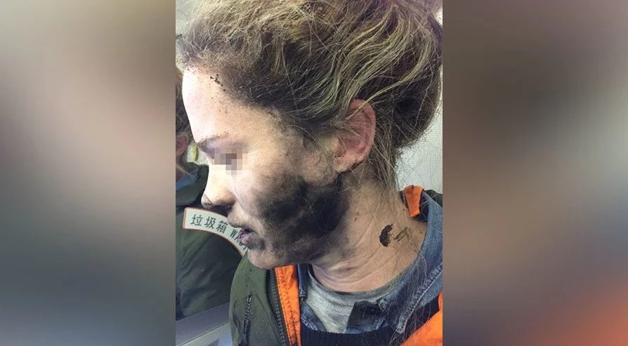 Woman's headphones EXPLODE mid-flight leaving her with facial burns (photos)