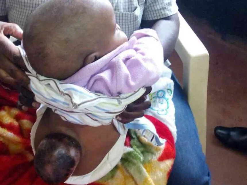 Baby born with two heads needs KSh350,000 for surgery
