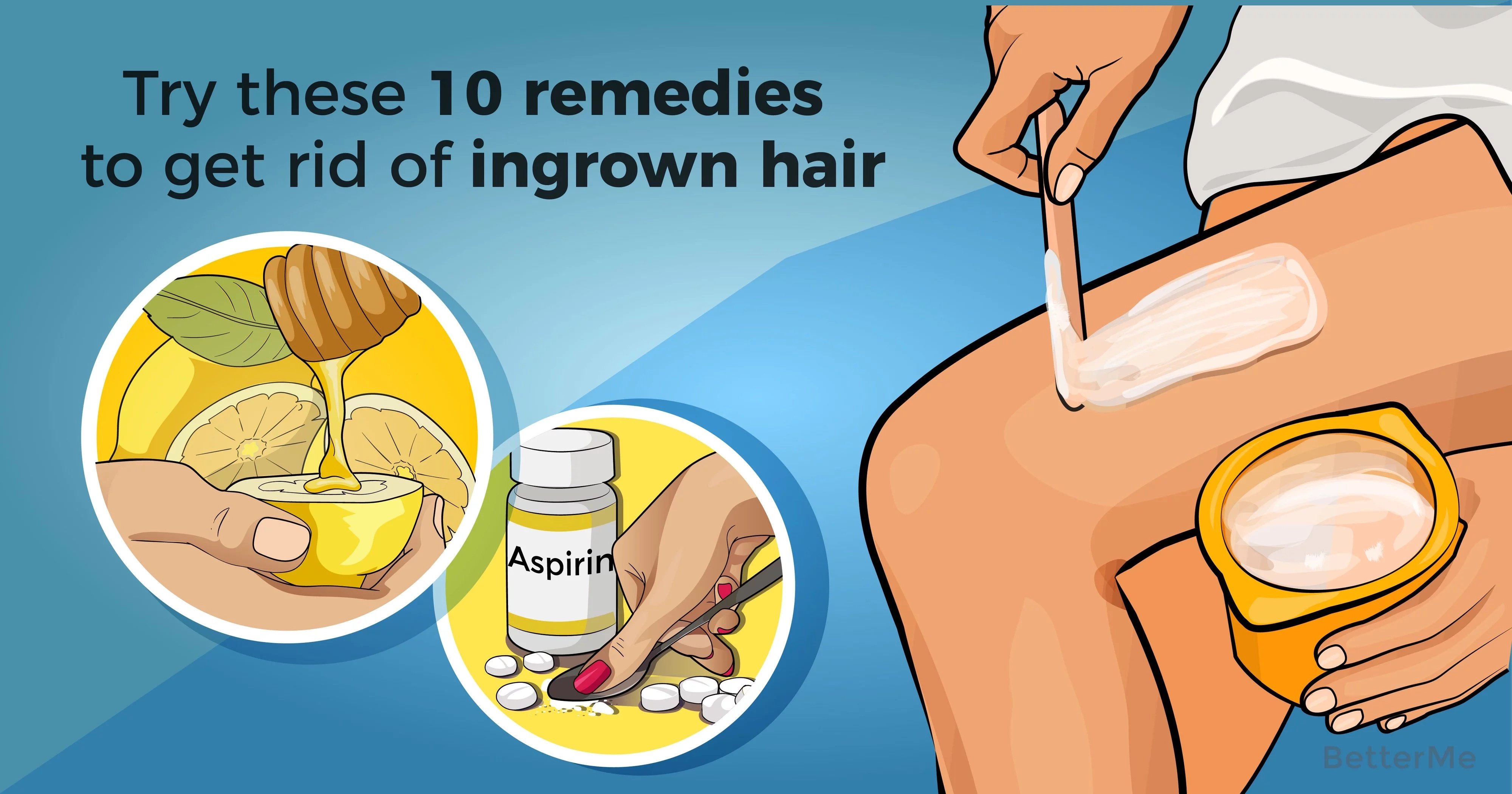 Try these 10 remedies to get rid of ingrown hair