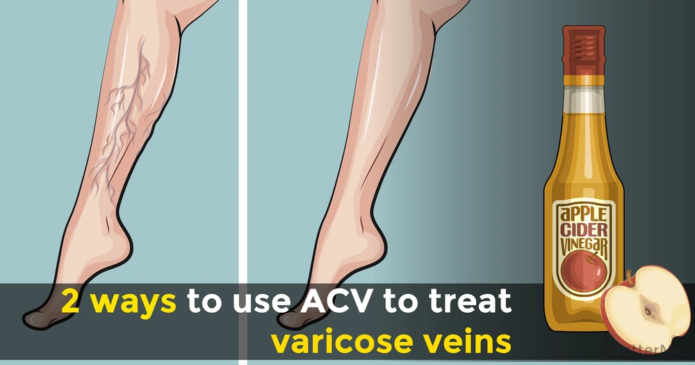 varicose remedy at home