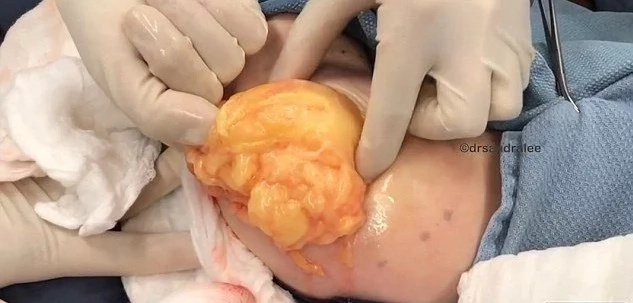 Disgusting Moment Doctor Removes HUGE Ball Of Fat From Woman's Arm Disgusting Moment Doctor Removes HUGE Ball Of Fat From Woman's Arm