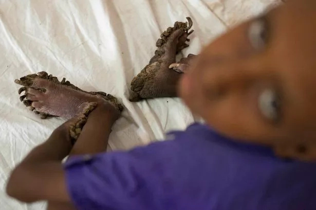 Young boy turns into a living tree due to rare disease (PHOTOS) Young boy turns into a living tree due to rare disease (PHOTOS)
