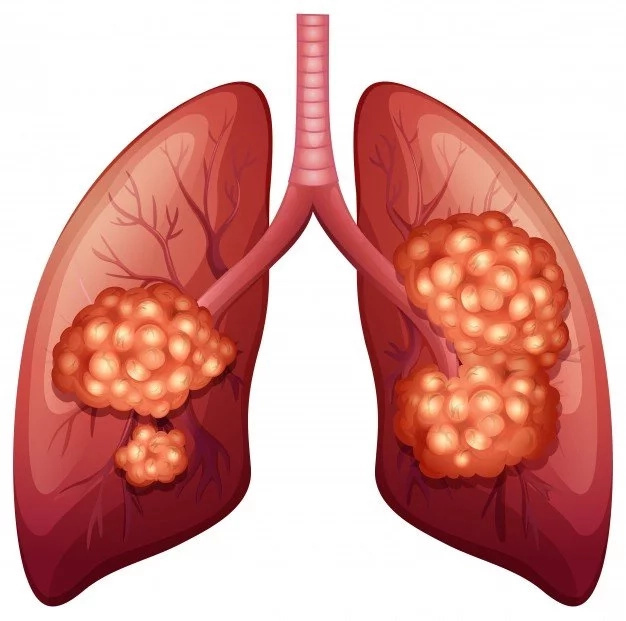 12 ways lung cancer manifests and how to prevent it