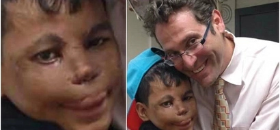 15-year-old boy receives first 3D printed nose after almost dying from this