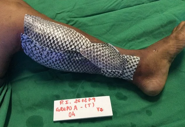 Fish Scales for Burn Treatment? Results are Definitely Unexpected! Fish Scales for Burn Treatment? Results are Definitely Unexpected!