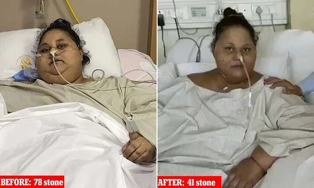 World's heaviest woman sits up for 1st time after losing half her weight World's heaviest woman sits up for 1st time after losing half her weight