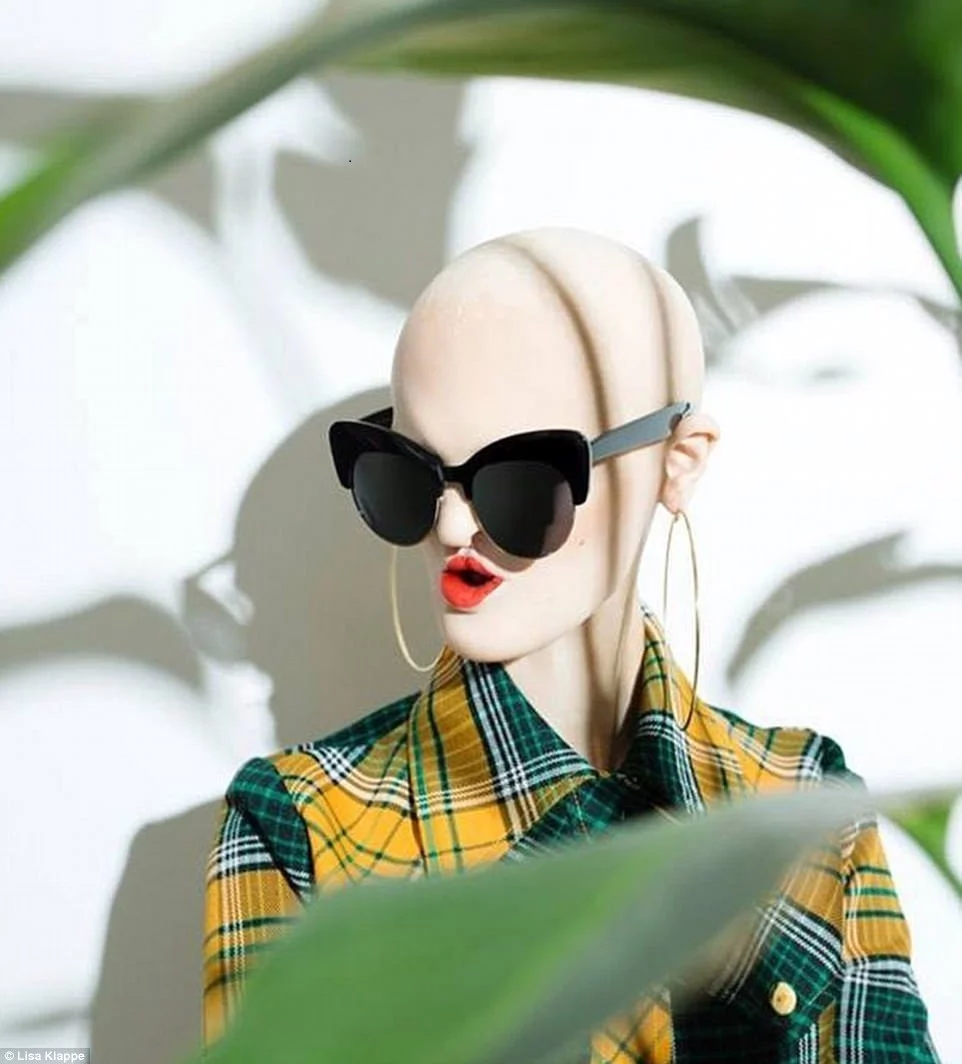 Model had a rare disease - she was bald and had no teeth. Her modelling career however, sky-rocketed after years of being a recluse Model had a rare disease - she was bald and had no teeth. Her modelling career however, sky-rocketed after years of being a recluse