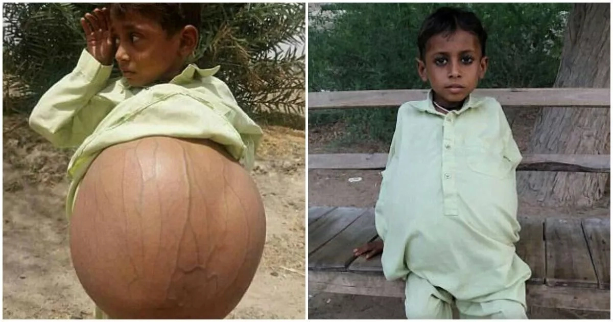 Meet 9-year-old boy who is 'pregnant' due to rare disease (photos, video)