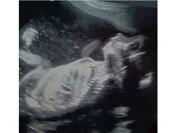 Infertile mom of 2 thinks cancer is back when she feels sick, finds out she’s 5 months pregnant Infertile mom of 2 thinks cancer is back when she feels sick, finds out she’s 5 months pregnant