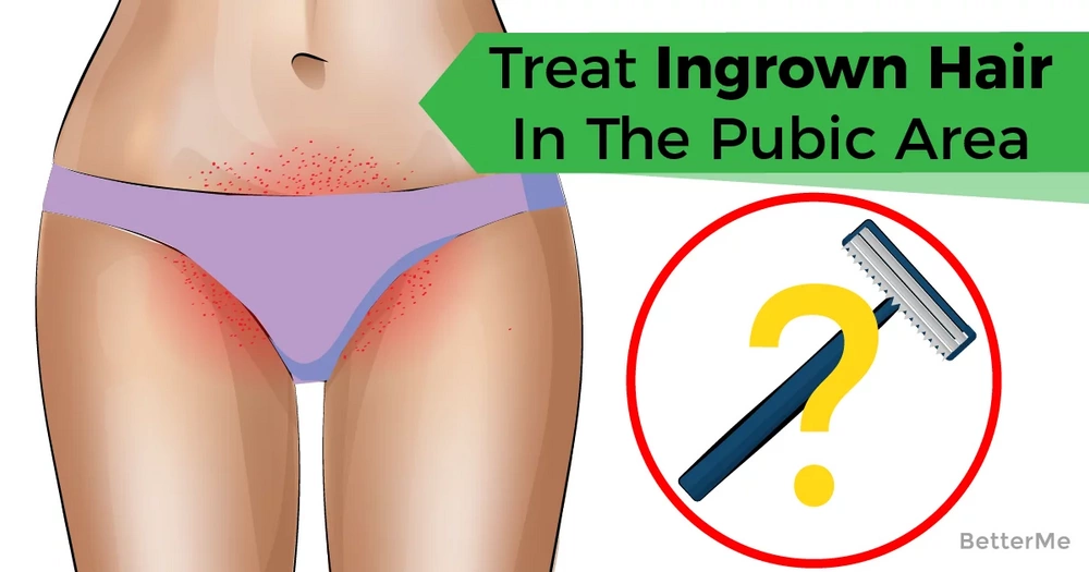 How To Deal With Ingrown Hairs In The Public Area-6534