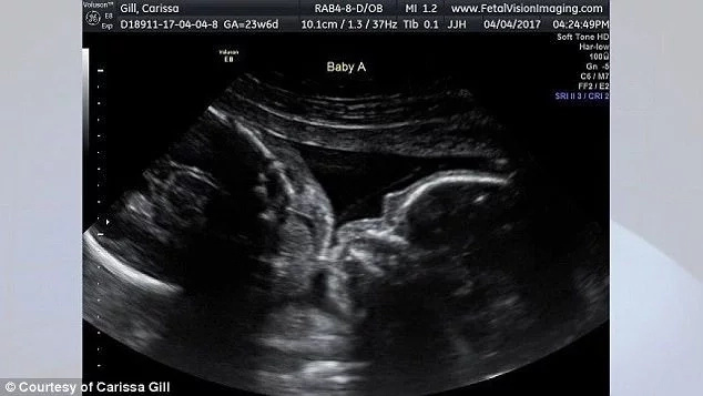 Couple watched how their twin girls kissing in ultrasound (photos) Couple watched how their twin girls kissing in ultrasound (photos)