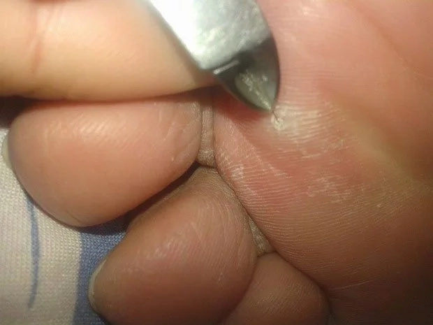 A strand of hair can cause pain on your feet! A strand of hair can cause pain on your feet!
