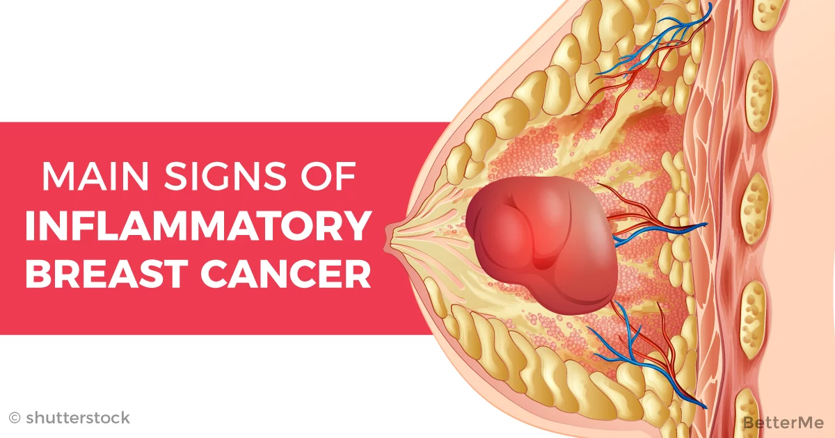 What Do Stages Of Breast Cancer Mean : Stage 4 breast cancer symptoms and prognosis - So, in order to choose and begin the best treatment, it is necessary to 'stage' breast cancer.