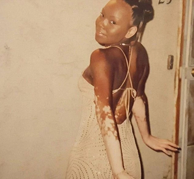 Mother, 33, with vitiligo shares photos to celebrate her uniqueness and empower women Mother, 33, with vitiligo shares photos to celebrate her uniqueness and empower women
