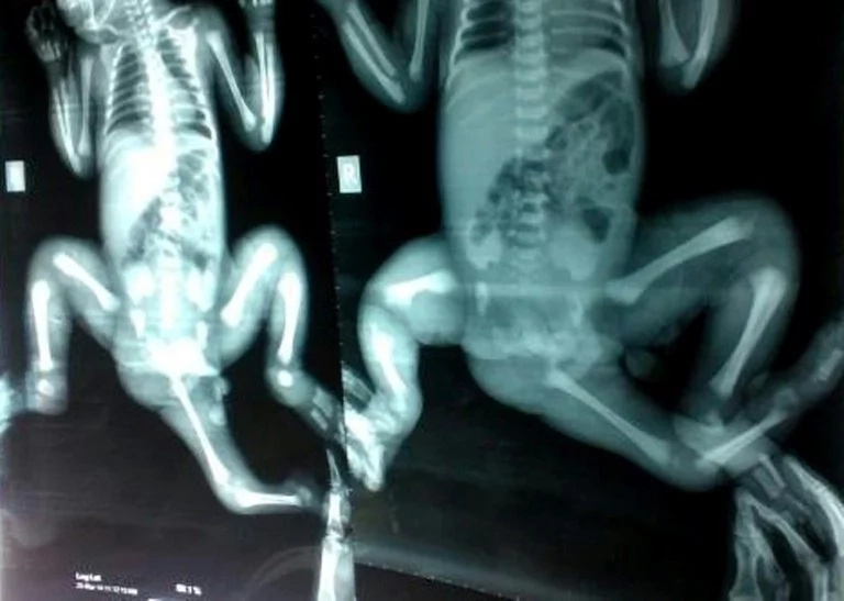 3-year-old toddler who was born with 3 legs can walk and run after surgery 3-year-old toddler who was born with 3 legs can walk and run after surgery