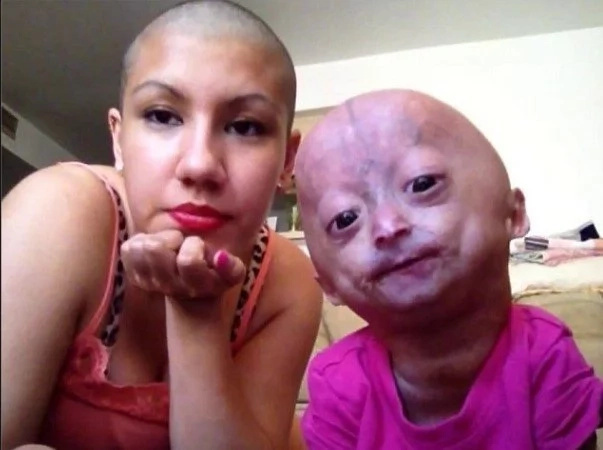 Mommy shaves her head to show support for her daughter with Progeria Mommy shaves her head to show support for her daughter with Progeria