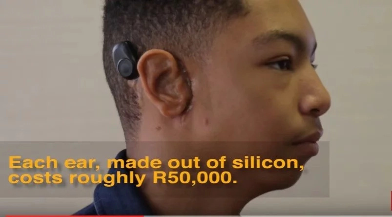 Teen gets gift of hearing after living without EARS for 15 years (photos, video)