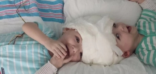 Conjoined twins, who shared one head, are successfully separated! Both toddlers survived! PHOTOS Conjoined twins, who shared one head, are successfully separated! Both toddlers survived! PHOTOS