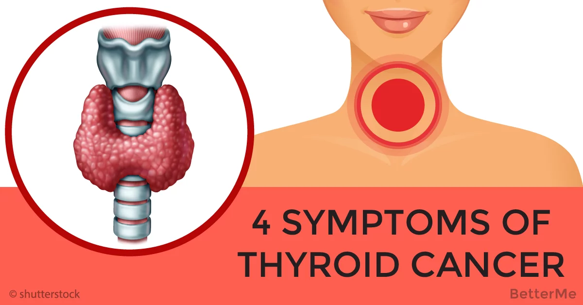 Cancer of the thyroid is very dangerous, because nobody ...