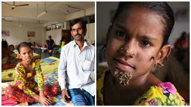 Girl, 10, who suffers from 'tree man syndrome' could die after father suddenly stops her treatment (photo)