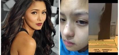Retokada ba talaga siya? Kim Chiu disproves rumors of having her nose done by showing photographic evidence on Instagram