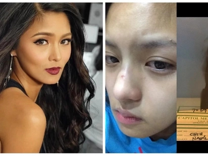 Retokada ba talaga siya? Kim Chiu disproves rumors of having her nose done by showing photographic evidence on Instagram