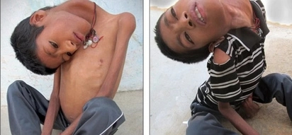 This boy’s disease makes his head hang 180 degrees; what this woman did for him will melt your heart