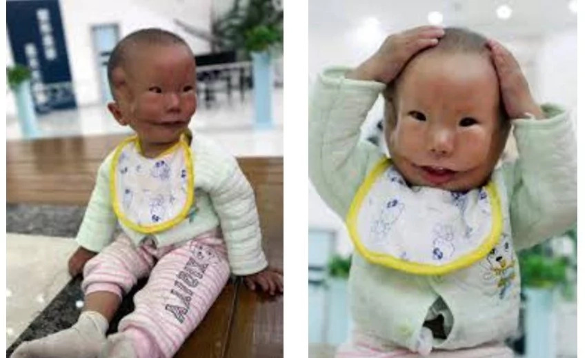 Story of boy born with 2 faces will break your heart (photos, video)