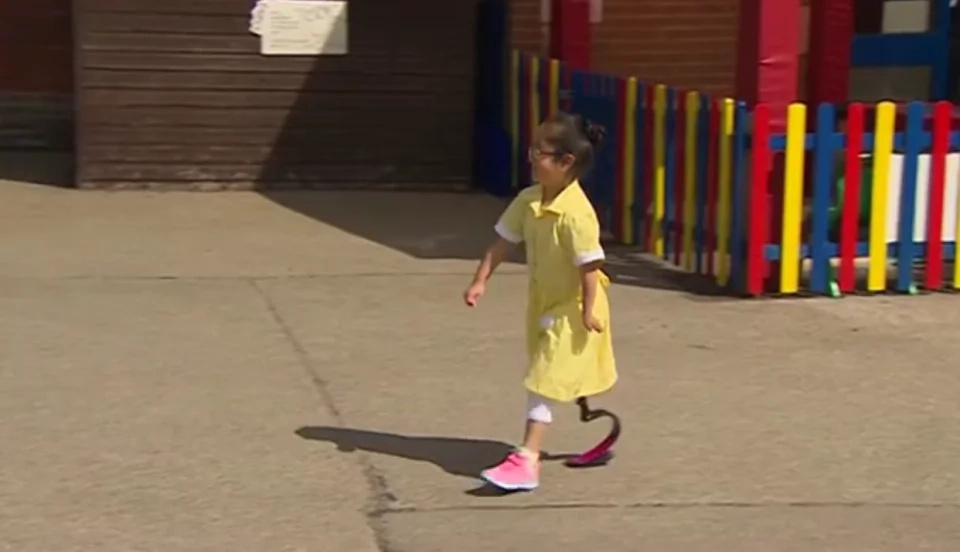 7-year-old disabled girl shows off her new leg for the first time 7-year-old disabled girl shows off her new leg for the first time