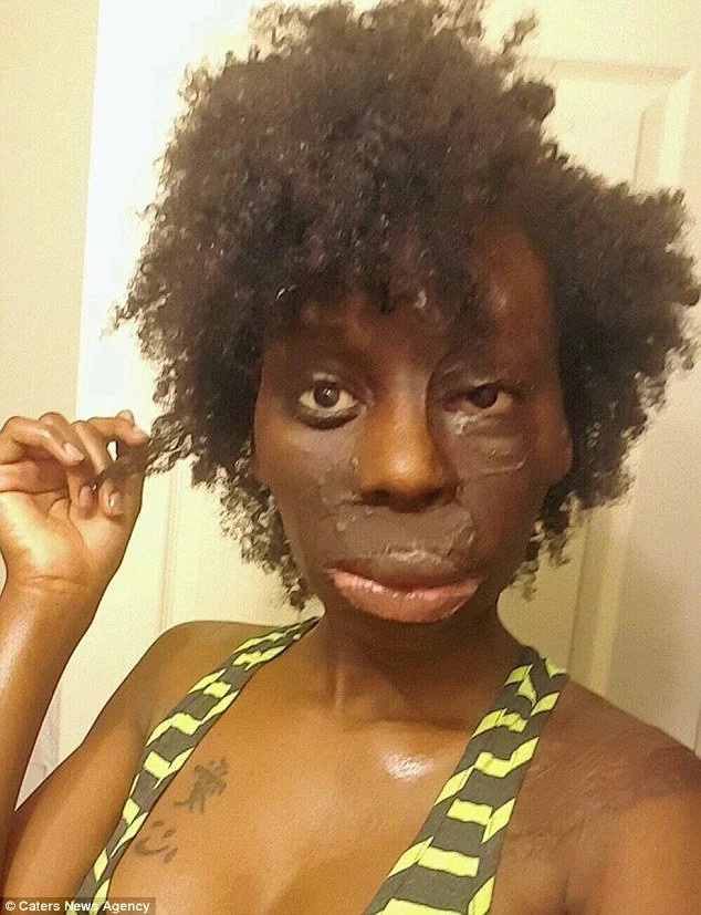 Meet burns survivor, 25, who wears her flaws like diamonds and rejects surgery (photos) Meet burns survivor, 25, who wears her flaws like diamonds and rejects surgery (photos)