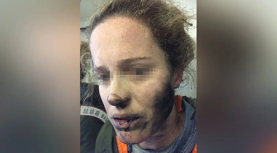 Woman's headphones EXPLODE mid-flight leaving her with facial burns (photos)