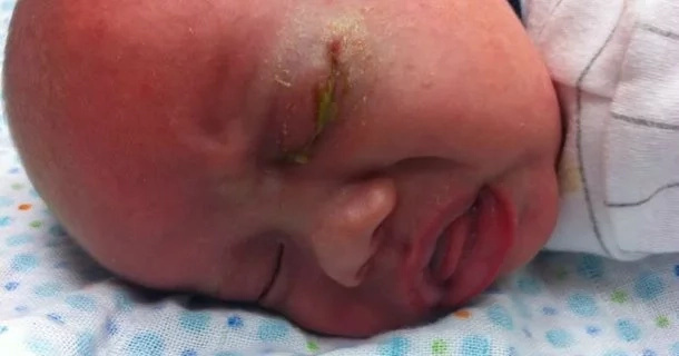 Infant becomes blind after relative snapped a photo with flash Infant becomes blind after relative snapped a photo with flash