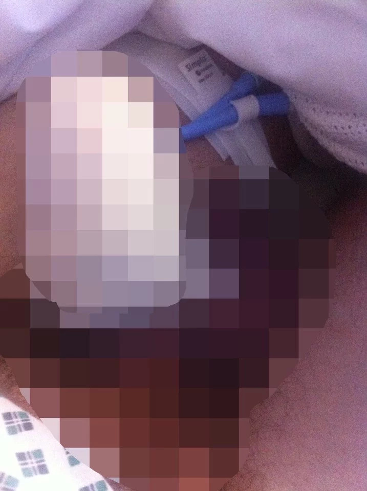 Bricklayer suffered injury after ‘rigorous doggy style’ caused his penis to snap in half (Photo) Bricklayer suffered injury after ‘rigorous doggy style’ caused his penis to snap in half (Photo)