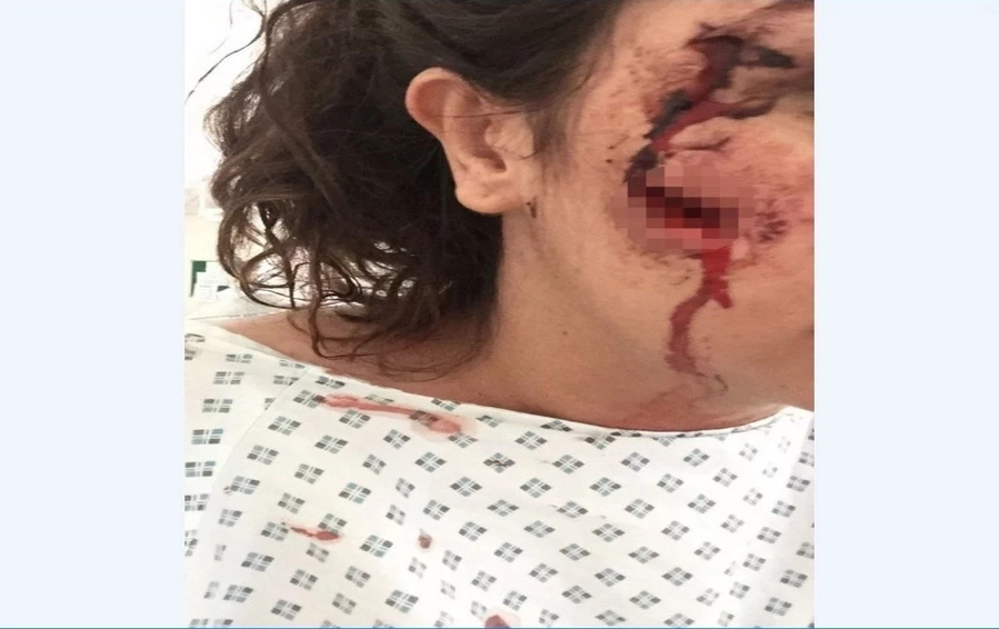 Woman, 25, left with permanent scars and facial twitches after female thug glassed her for smiling at her in a bar Woman, 25, left with permanent scars and facial twitches after female thug glassed her for smiling at her in a bar